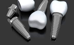 4 On Dental Implants Las Vegas