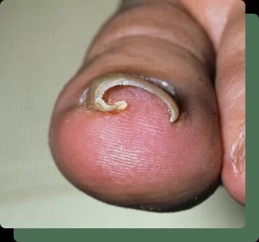 Ingrown Nail Removal Near Me