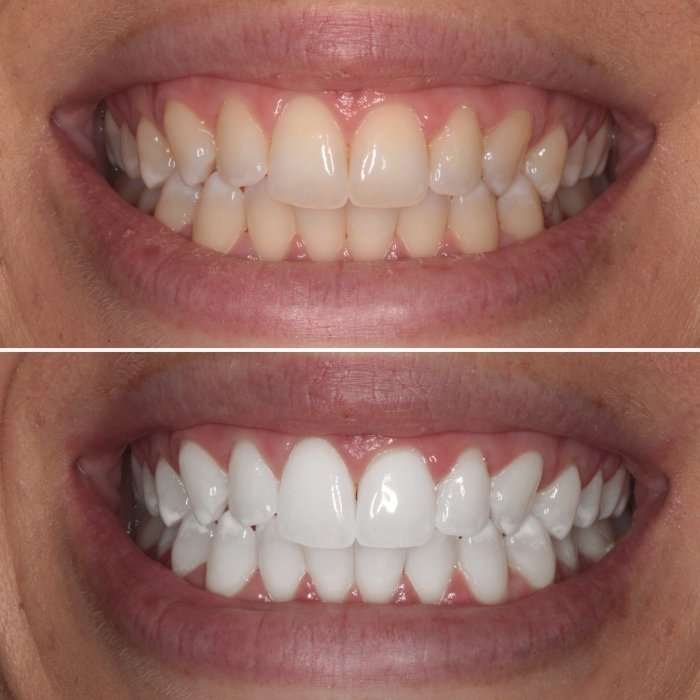 Tooth Bleaching Solutions with Modern Techniques