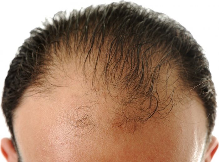 Hair Loss Treatment Delhi: Understanding the Role of Minoxidil in Hair Regrowth