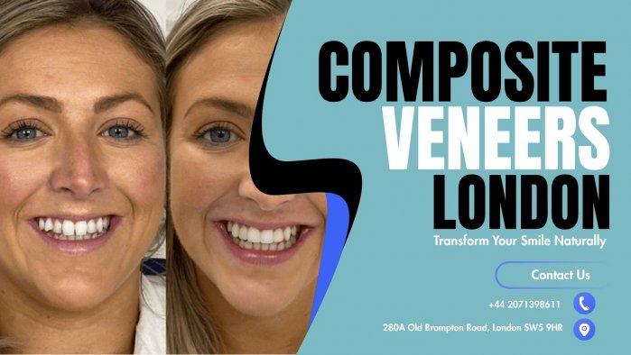 Composite Veneers London | Transform Your Smile Naturally
