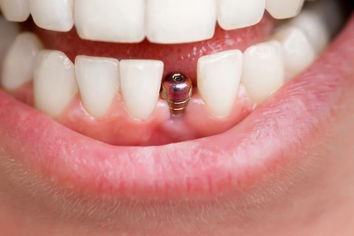 Emergency Dentist in Hills – Prompt Dental Care